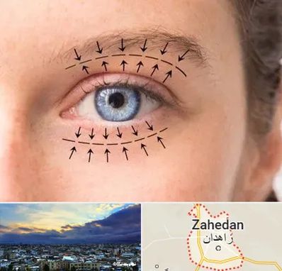 عمل افتادگی پلک در زاهدان