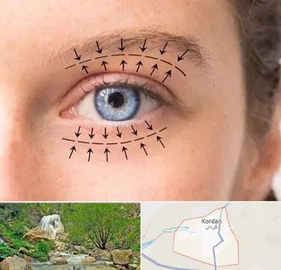 عمل افتادگی پلک در کردان