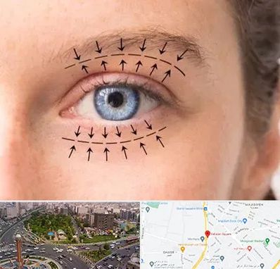 عمل افتادگی پلک در سبلان