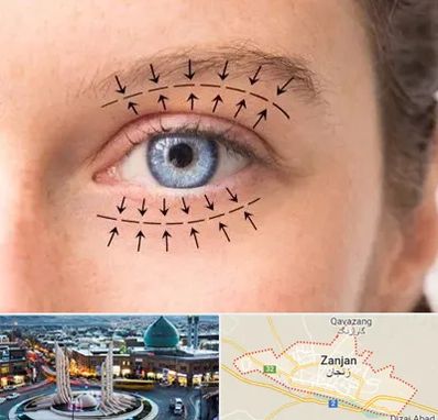 عمل افتادگی پلک در زنجان