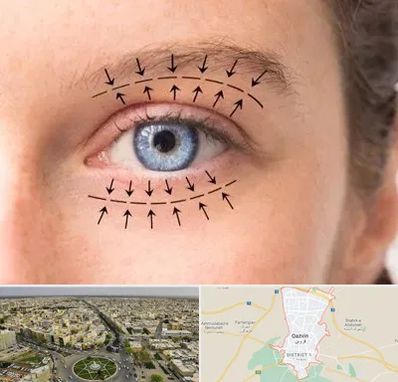 عمل افتادگی پلک در قزوین