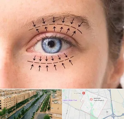 عمل افتادگی پلک در فاز سه اندیشه