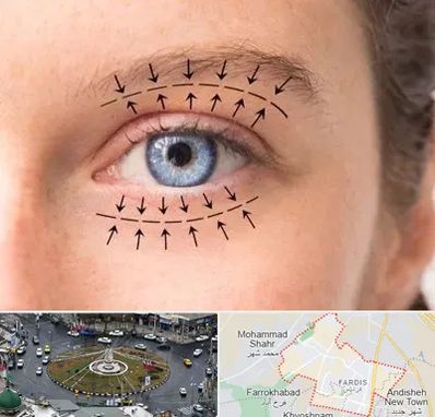 عمل افتادگی پلک در فردیس کرج