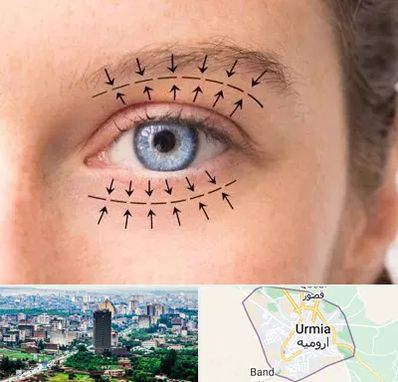 عمل افتادگی پلک در ارومیه
