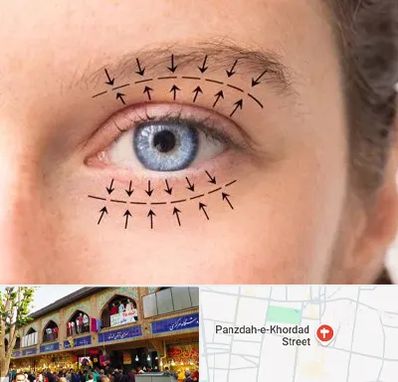 عمل افتادگی پلک در 15 خرداد