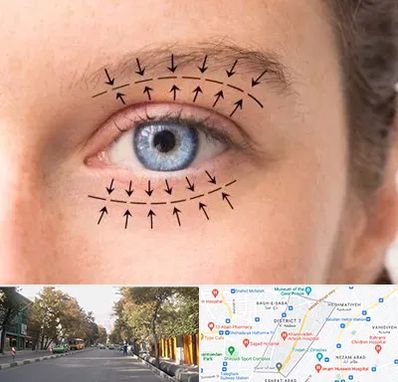 عمل افتادگی پلک در شریعتی