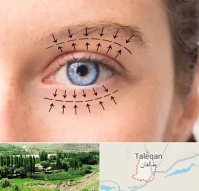 عمل افتادگی پلک در طالقان