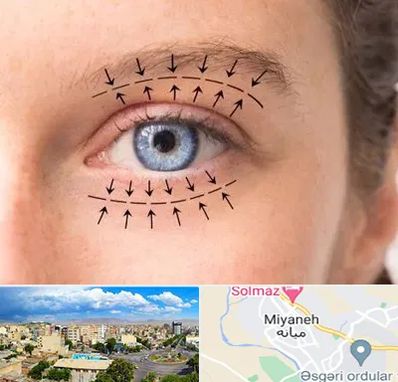 عمل افتادگی پلک در میانه