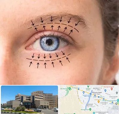 عمل افتادگی پلک در صیاد شیرازی مشهد