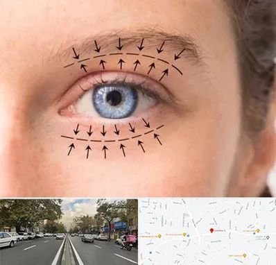 عمل افتادگی پلک در دولت