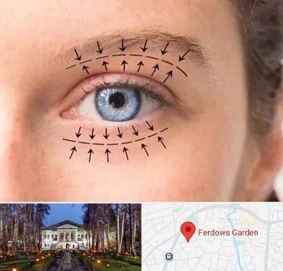 عمل افتادگی پلک در باغ فردوس