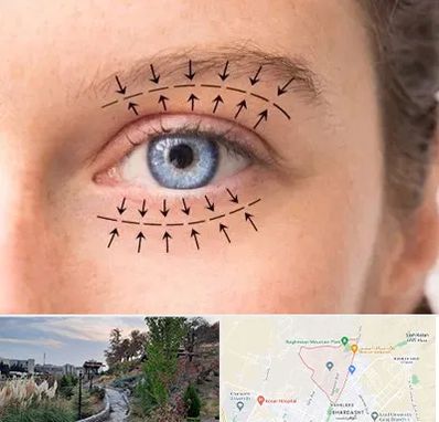 عمل افتادگی پلک در باغستان کرج