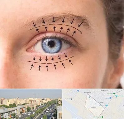 عمل افتادگی پلک در کیانمهر کرج