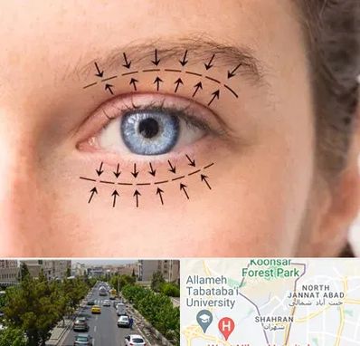 عمل افتادگی پلک در شهران