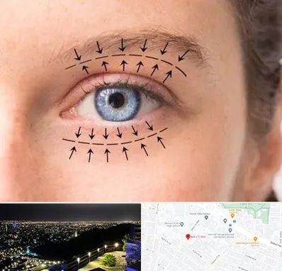 عمل افتادگی پلک در هفت تیر مشهد