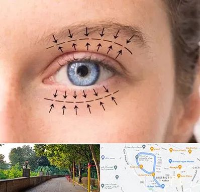 عمل افتادگی پلک در بلوار گیلان رشت