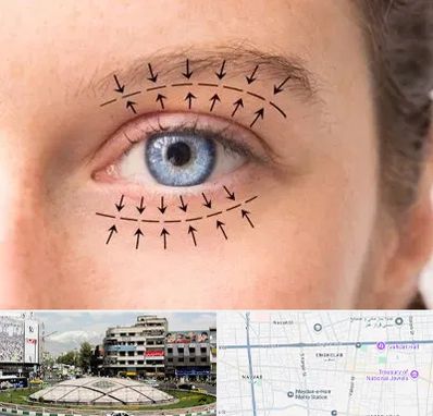 عمل افتادگی پلک در مرکز تهران