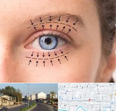 عمل افتادگی پلک در ضیابری رشت