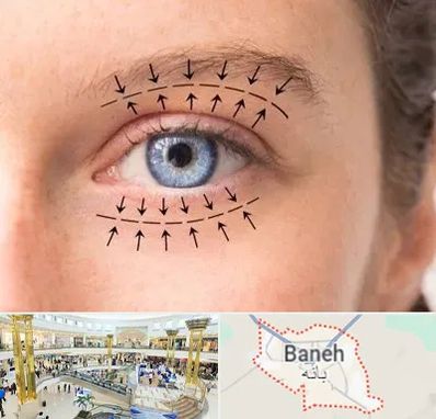 عمل افتادگی پلک در بانه
