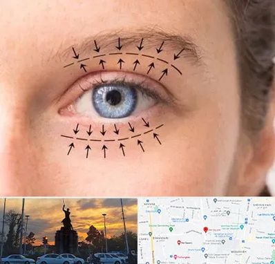 عمل افتادگی پلک در میدان حر