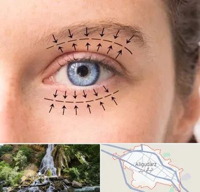 عمل افتادگی پلک در الیگودرز