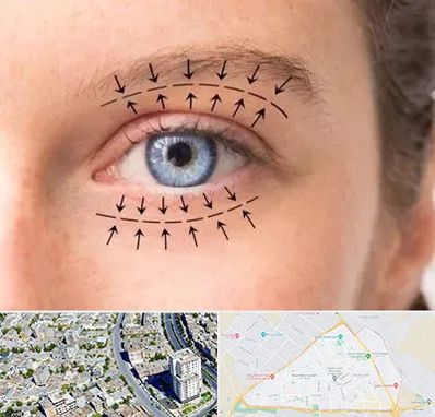 عمل افتادگی پلک در قاسم آباد مشهد