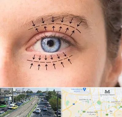 عمل افتادگی پلک در جنوب تهران