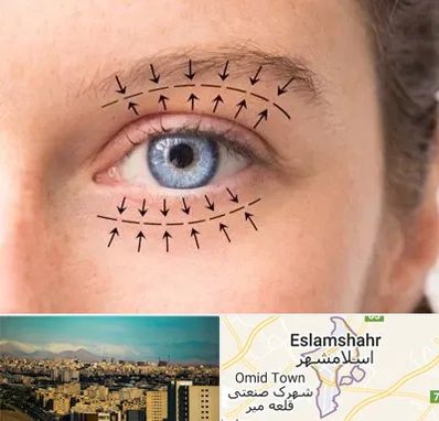 عمل افتادگی پلک در اسلامشهر