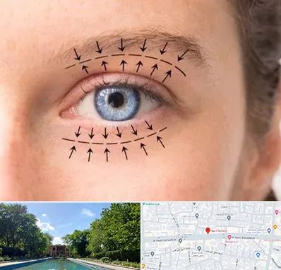 عمل افتادگی پلک در هشت بهشت اصفهان