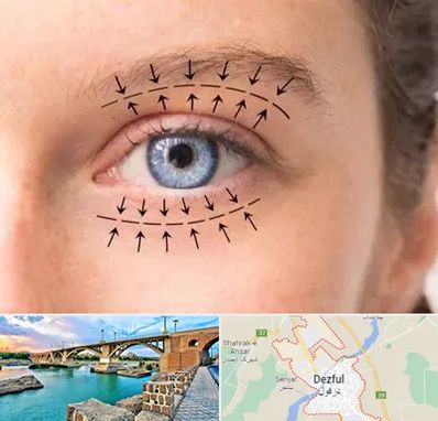 عمل افتادگی پلک در دزفول