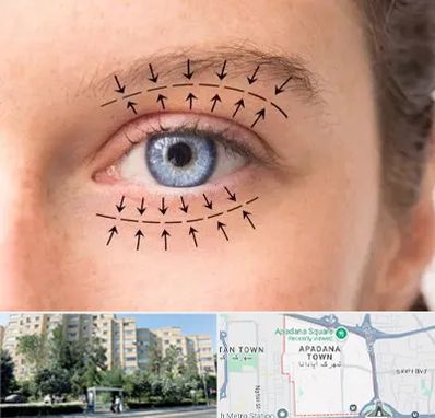 عمل افتادگی پلک در آپادانا