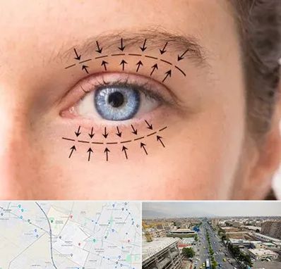 عمل افتادگی پلک در حصارک کرج