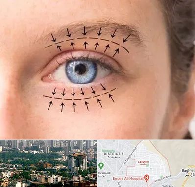 عمل افتادگی پلک در عظیمیه کرج