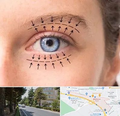 عمل افتادگی پلک در مهرویلا کرج