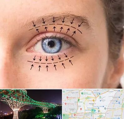 عمل افتادگی پلک در منطقه 3 تهران