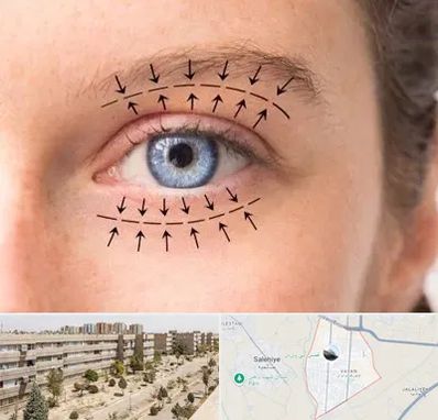 عمل افتادگی پلک در واوان اسلامشهر