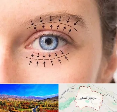 عمل افتادگی پلک در خراسان شمالی