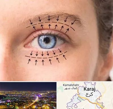 عمل افتادگی پلک در کرج