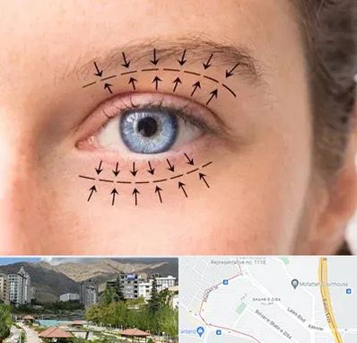 عمل افتادگی پلک در شهر زیبا