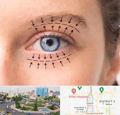 عمل افتادگی پلک در ونک تهران