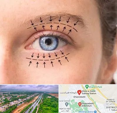 عمل افتادگی پلک در قصرالدشت شیراز
