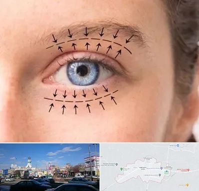 عمل افتادگی پلک در ماهدشت کرج