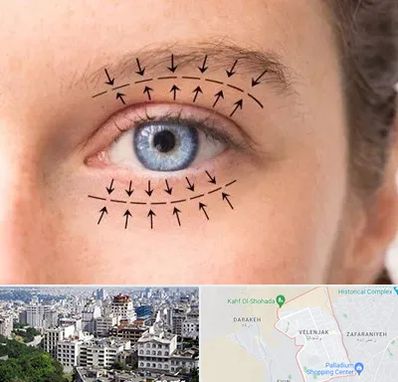 عمل افتادگی پلک در ولنجک