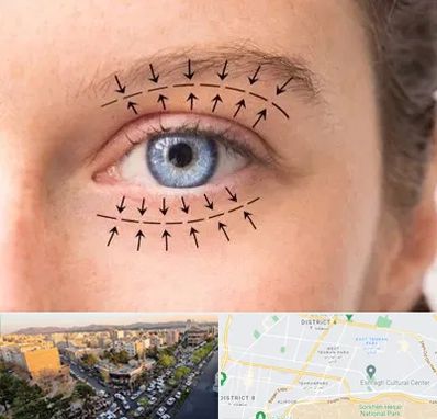 عمل افتادگی پلک در تهرانپارس تهران