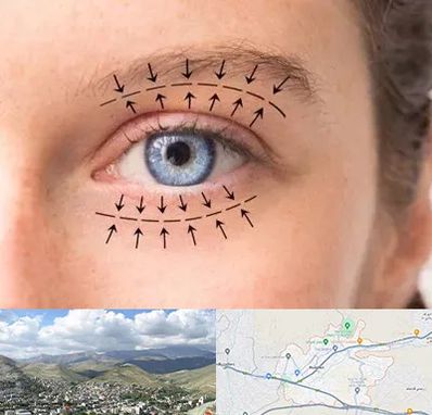 عمل افتادگی پلک در رودهن