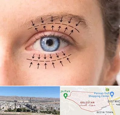 عمل افتادگی پلک در شهرک گلستان شیراز