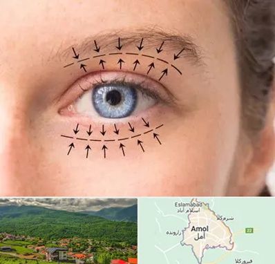 عمل افتادگی پلک در آمل