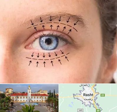 عمل افتادگی پلک در رشت