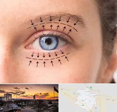 عمل افتادگی پلک در قوچان