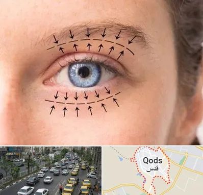 عمل افتادگی پلک در شهر قدس